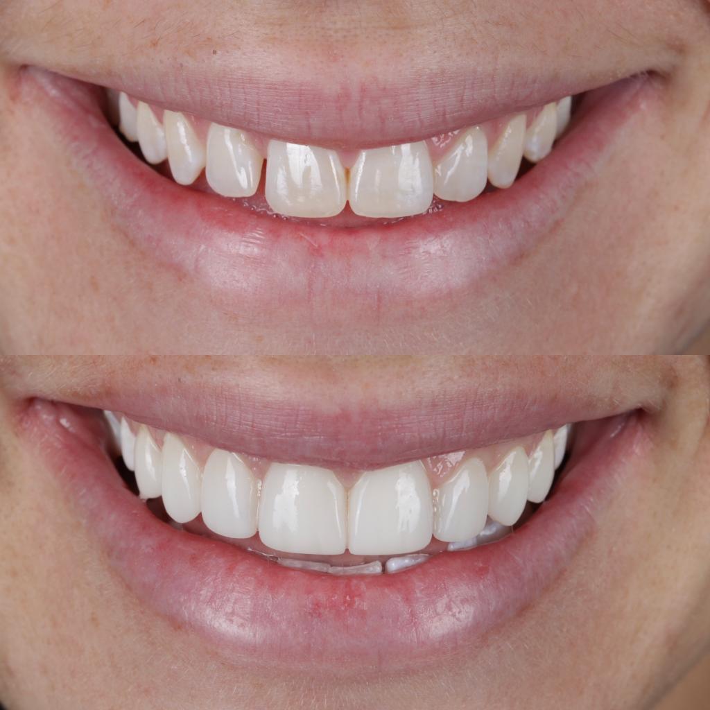Composite Bonding