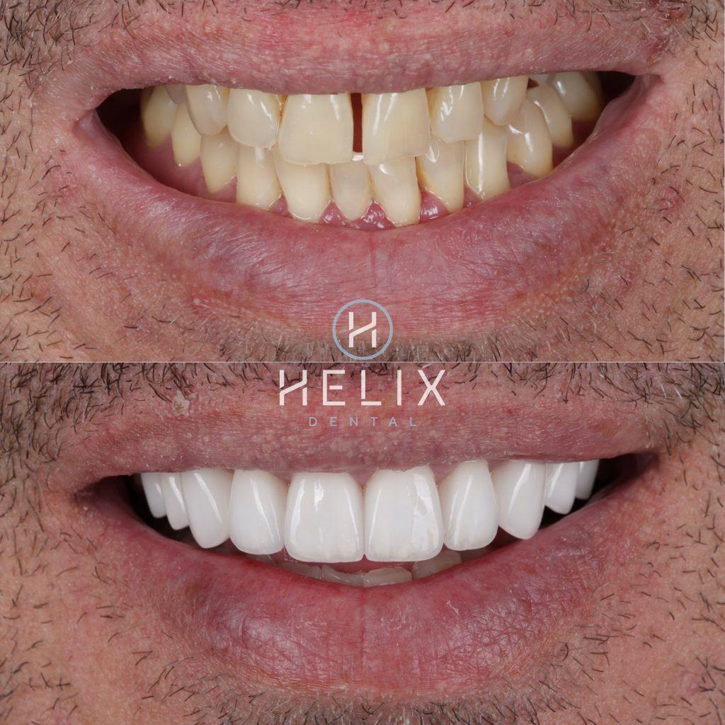 10 Porcelain Veneers Feldspathic