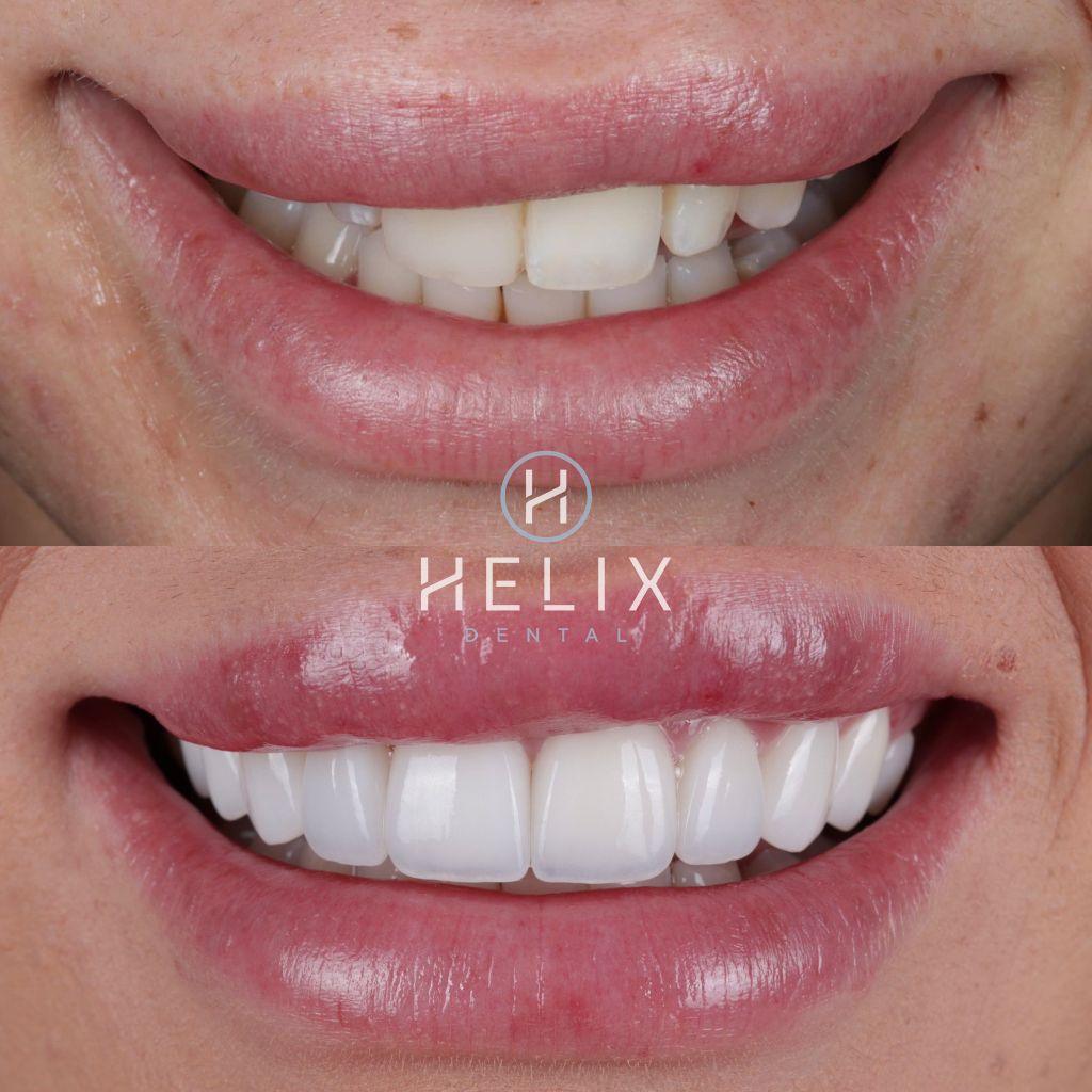 10 Porcelain Veneers Emax