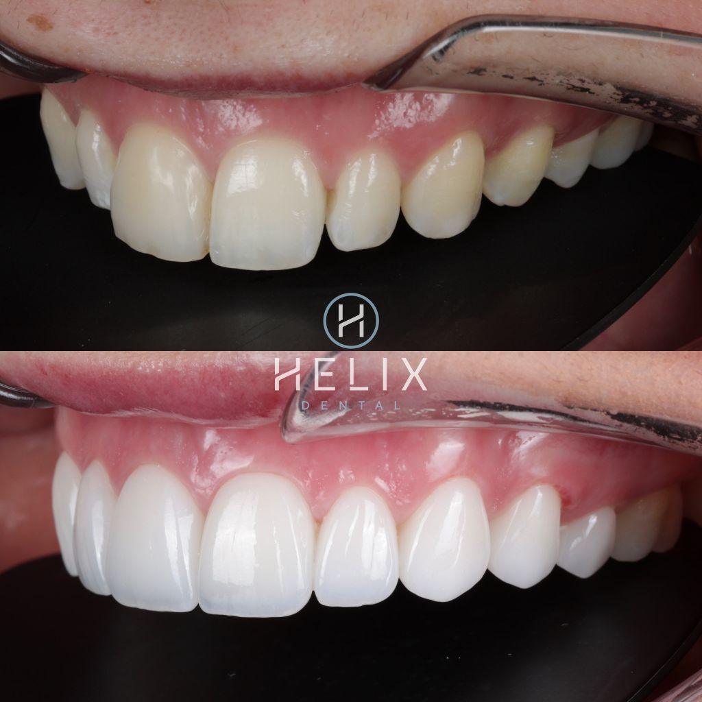 10 Porcelain Veneers Emax