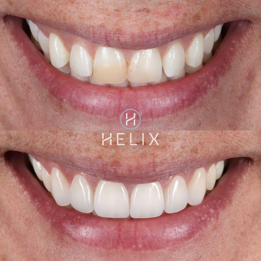 6 Porcelain Veneers Emax