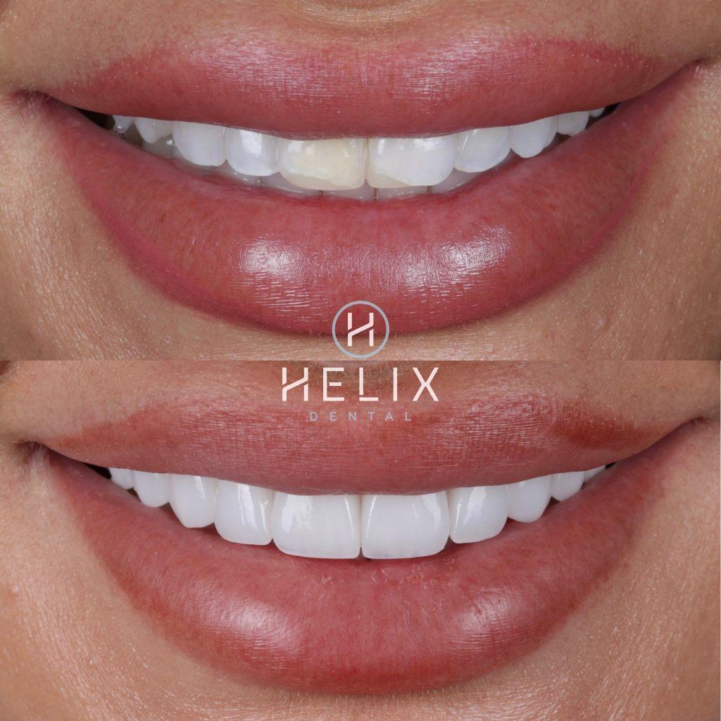 10 Porcelain Veneers Emax