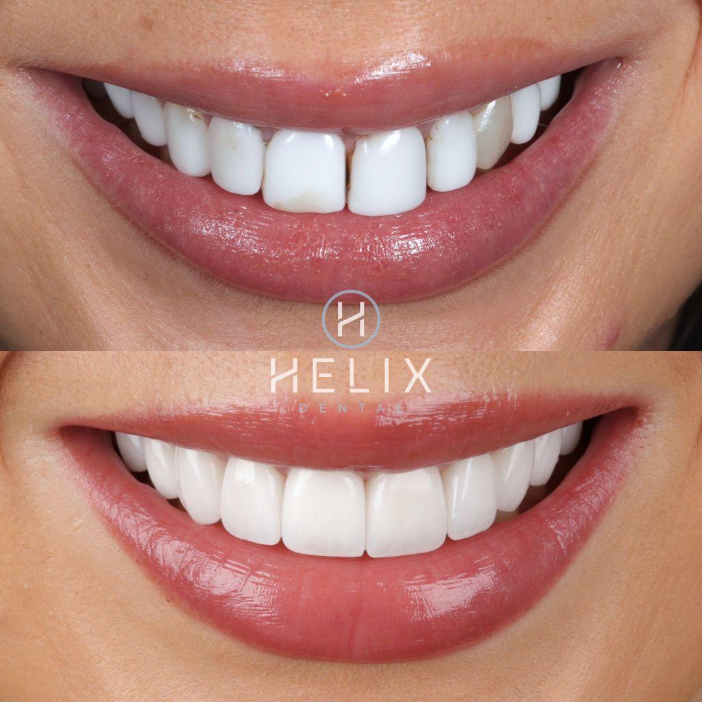 10 Porcelain Veneers Emax