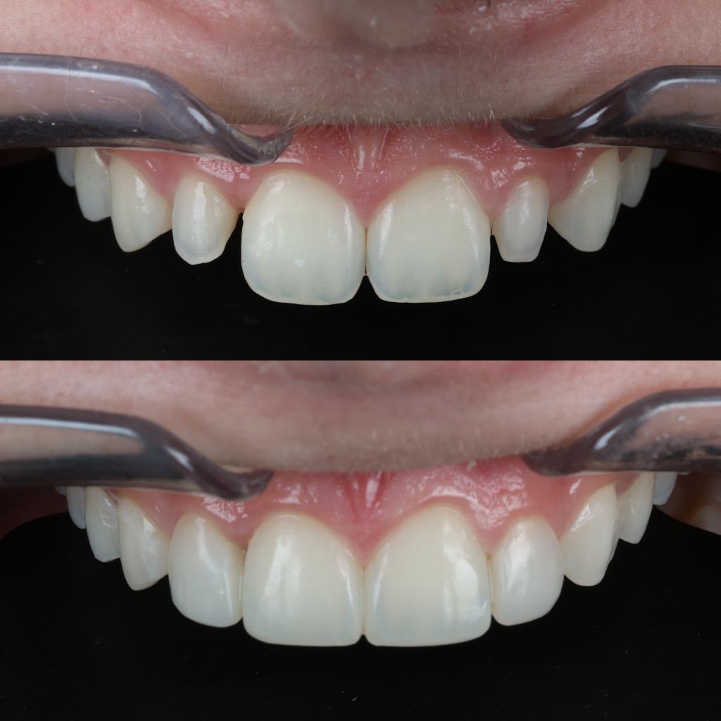 Composite Bonding