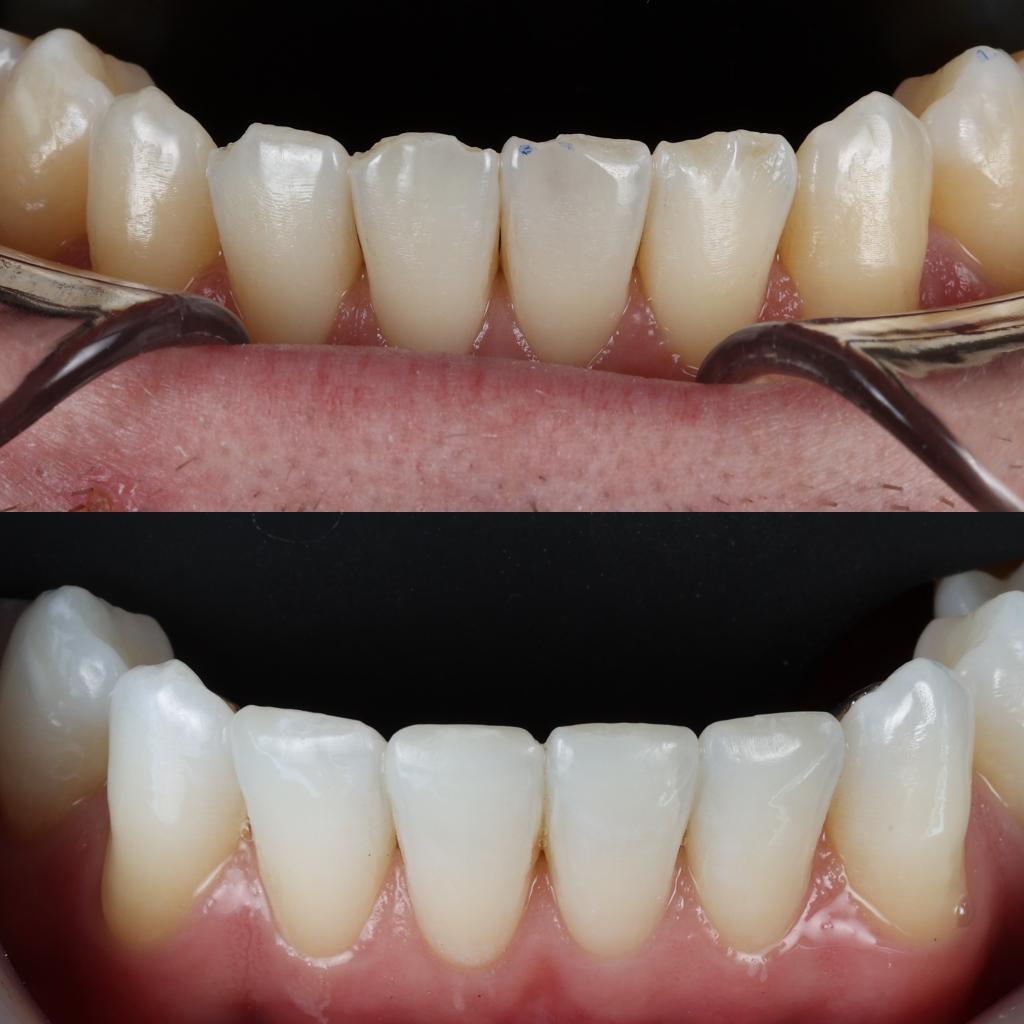 Composite Bonding