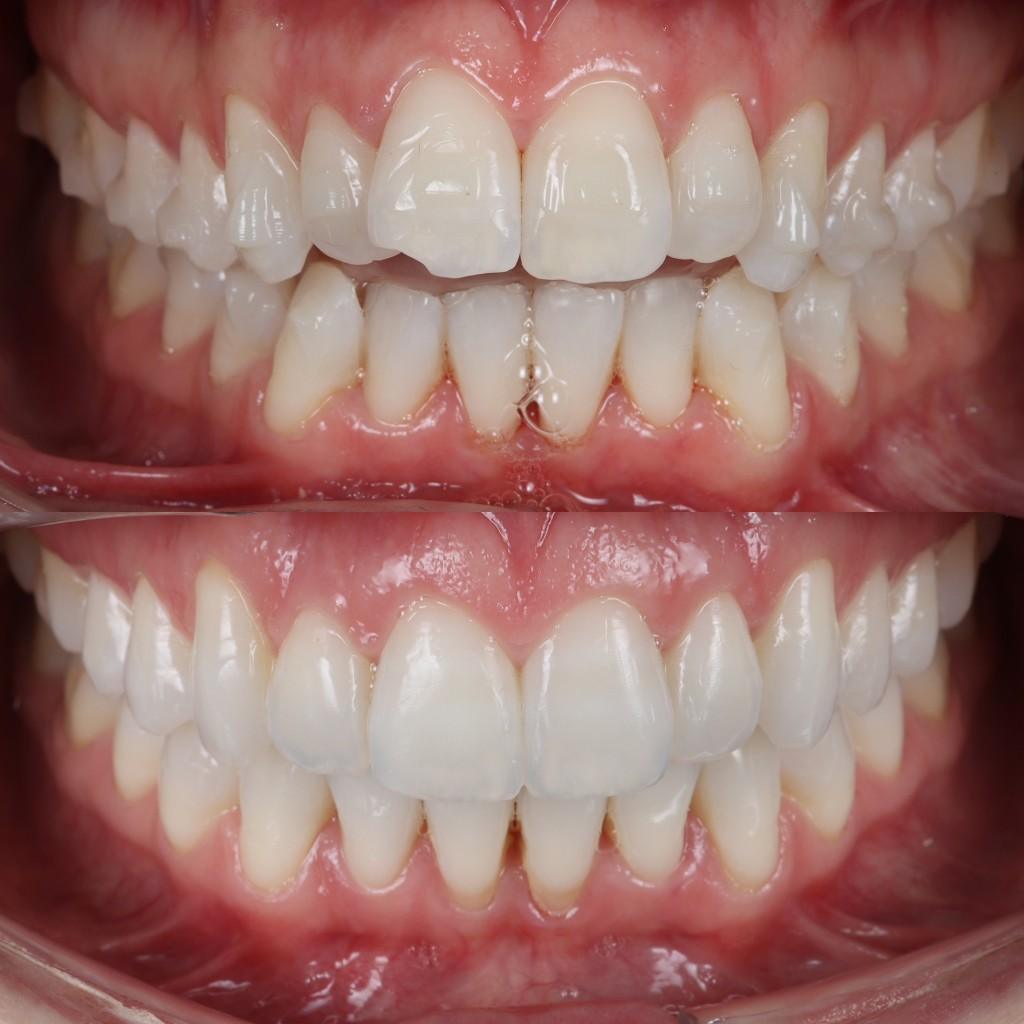 Clear aligner result