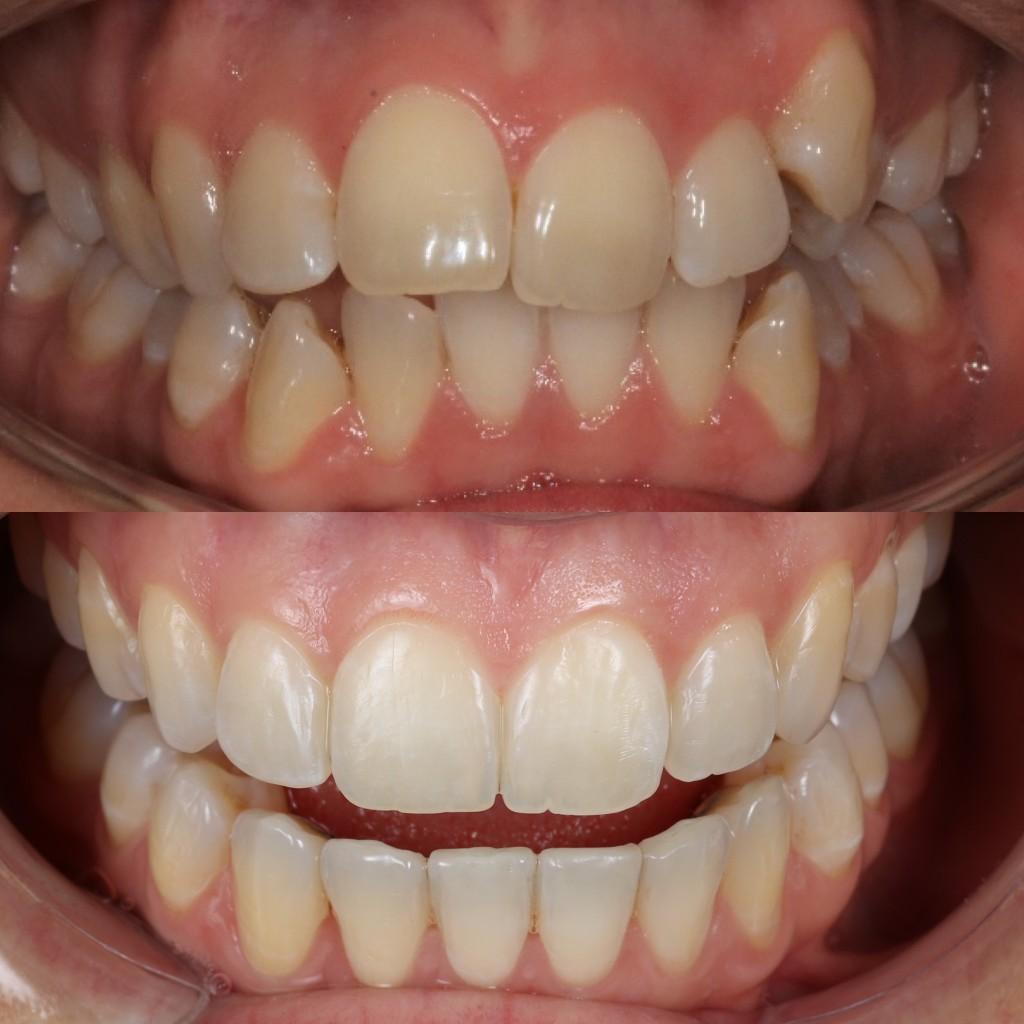 Clear aligner result