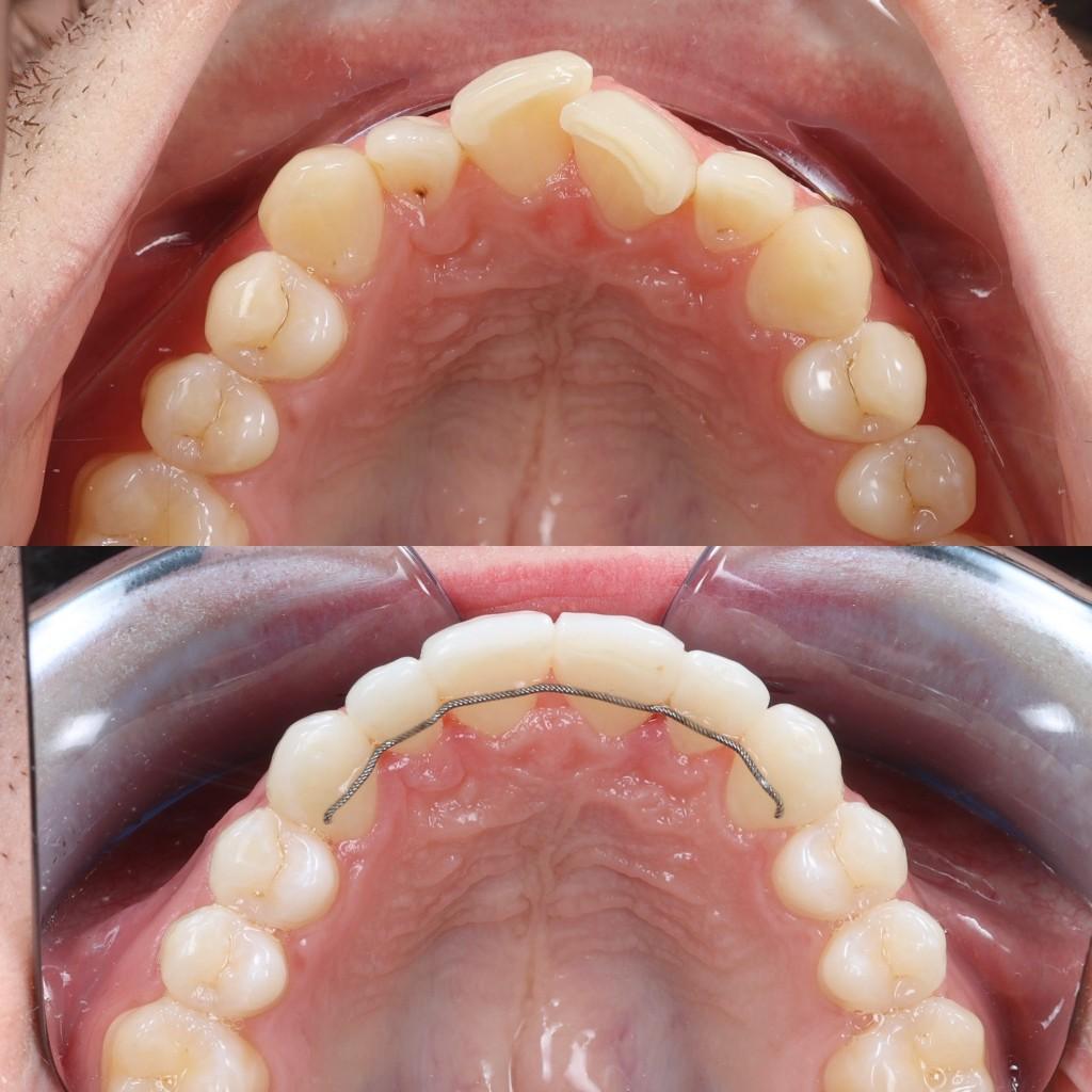 Clear aligner result