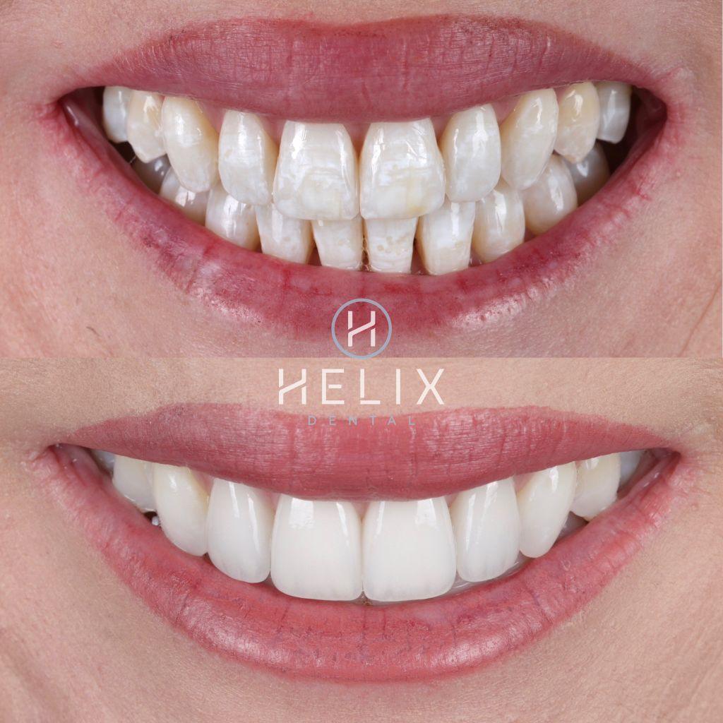 Porcelain veneers with whitening