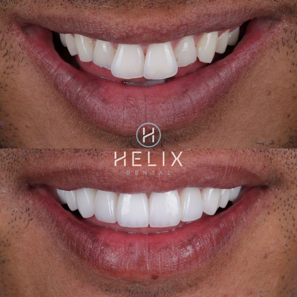 10 Porcelain Veneers Emax