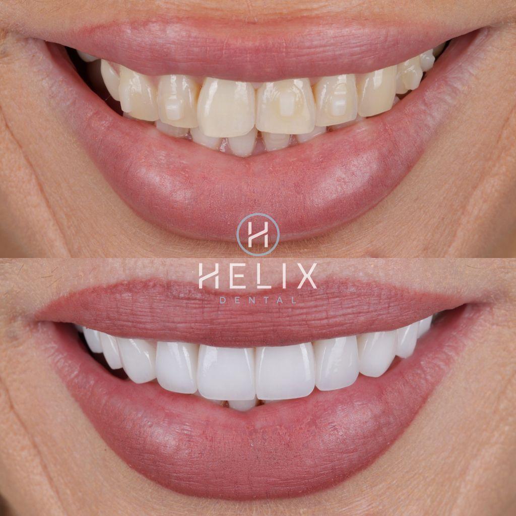 10 Porcelain Veneers Emax